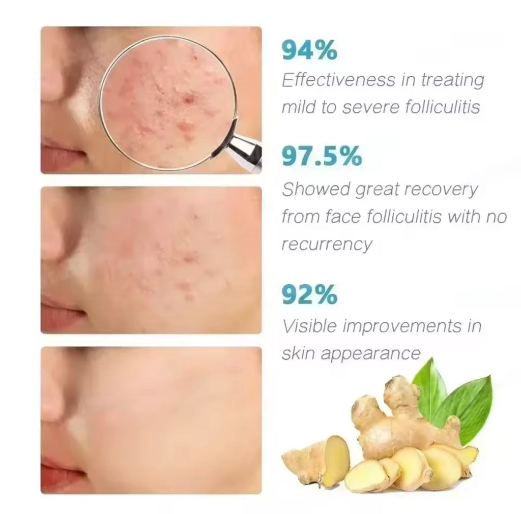 Crème Anti-Acné Purifiante – Soin Anti-Imperfections